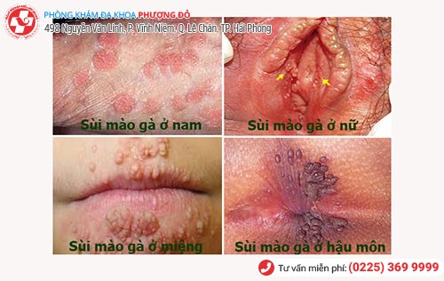 Các dấu hiệu nhận biết bệnh sùi mào gà Các dấu hiệu nhận biết bệnh sùi mào gà