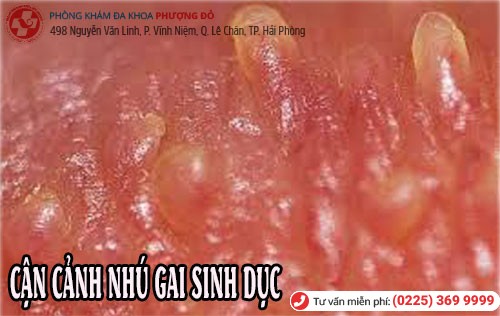 Nhú gai sinh dục ở nam Cận cảnh nhú gai sinh dục