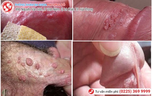 Hình ảnh chim nổi mẩn đỏ Hình ảnh chim nổi mẩn đỏ