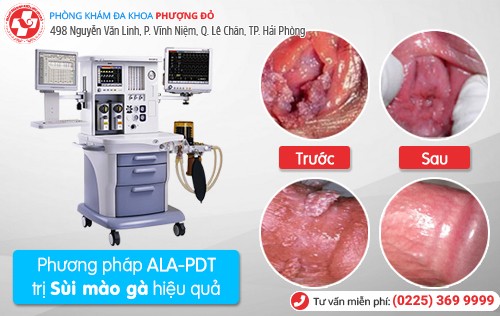 Chữa bệnh sùi mào gà ở đâu tốt nhất tại Hải Phòng? Chữa bệnh sùi mào gà ở đâu tốt nhất tại Hải Phòng?