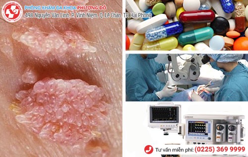 Phương pháp hỗ trợ điều trị sùi mào gà an toàn Sùi mào gà chữa được không
