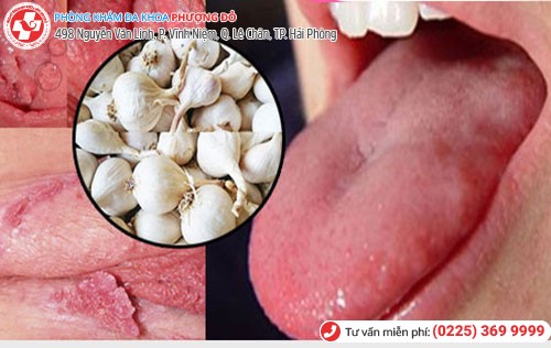 Chữa sùi mào gà bằng tỏi tại nhà Chữa sùi mào gà bằng tỏi tại nhà