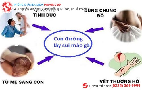 Sùi mào gà có tốc độ lây nhiễm nhanh Sùi mào gà có tốc độ lây nhiễm nhanh