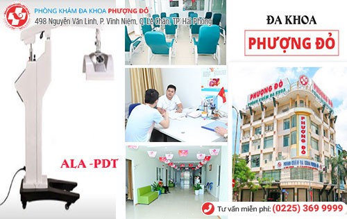 ALA-PDT phương pháp chữa sùi mào gà hiệu quả hiện nay ALA-PDT phương pháp chữa sùi mào gà hiệu quả hiện nay