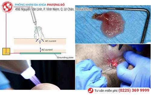 Đốt sùi mào gà - 1 phương pháp chữa sùi mào gà Đốt sùi mào gà - 1 phương pháp chữa sùi mào gà