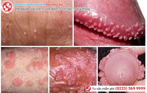 Hình ảnh nổi mụn dương vật Hình ảnh nổi mụn dương vật