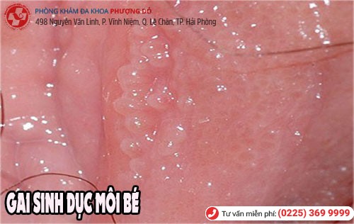 Gai sinh dục ở môi bé âm đạo Gai sinh dục ở môi bé
