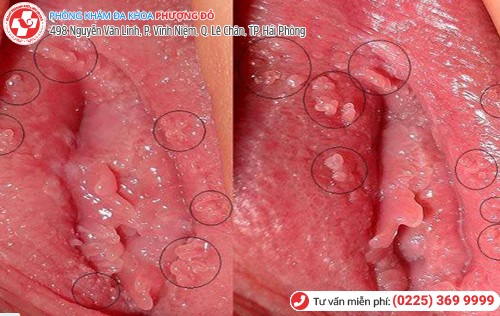 Gai sinh dục phát triển nhiều bên trong âm đạo Gai sinh dục phát triển nhiều bên trong âm đạo