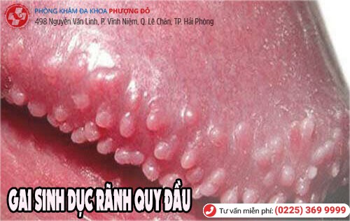 Rãnh quy đầu nổi gai sinh dục Gai sinh dục ở rãnh quy đầu