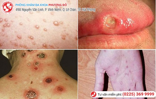 Hình ảnh bệnh giang mai ở nữ giới Hình ảnh bệnh giang mai ở nữ giới