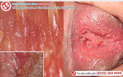 Hình ảnh gai sinh dục ở nữ Hình ảnh gai sinh dục ở nữ