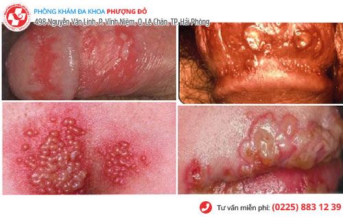 Mụn rộp sinh dục nam giai đoạn cuối Mụn rộp sinh dục nam giai đoạn cuối