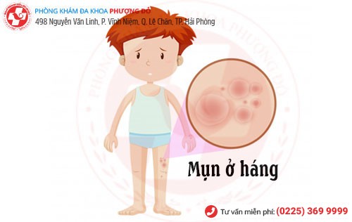 Nguyên nhân mụn ở háng Mụn ở háng