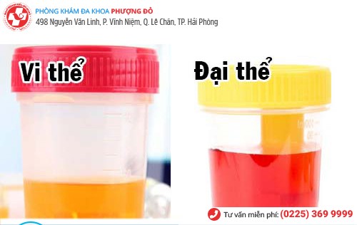 Các dạng tiểu lẫn máu Các dạng tiểu lẫn máu
