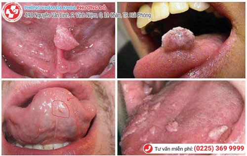 Sùi mào gà ở lưỡi Sùi mào gà ở lưỡi