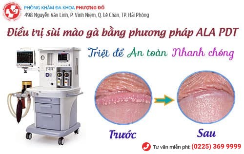 cách chữa sùi mào gà