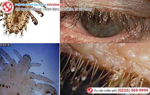 Rận mu gây nhiều biến chứng nguy hiểm Rận mu gây nhiều biến chứng nguy hiểm