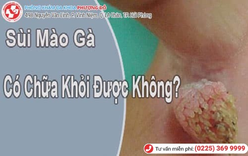 sùi mào gà có chữa khỏi được không sùi mào gà có chữa khỏi được không