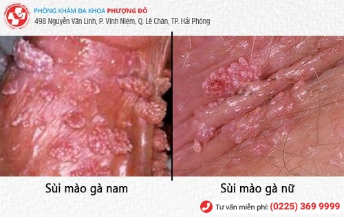 sùi mào gà bệnh xã hội