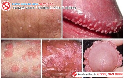 Sùi mào gà ở dương vật Sùi mào gà ở dương vật