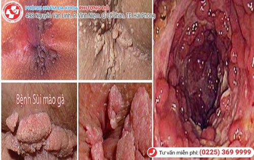 Sùi mào gà ở hậu môn Sùi mào gà ở hậu môn