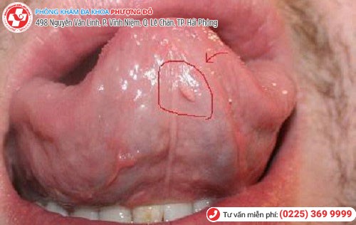 Sùi mào gà ở lưỡi Sùi mào gà ở lưỡi