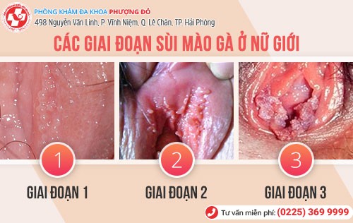 biểu hiện sùi mào gà nữ