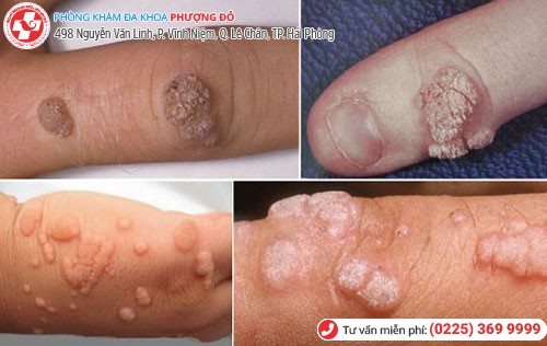 Hình ảnh bệnh mào gà ở chân tay Hình ảnh bệnh mào gà ở chân tay