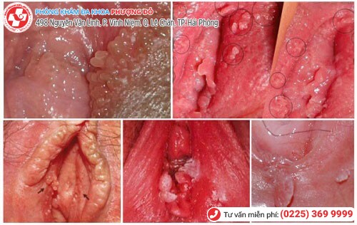 Hình ảnh sùi mào gà ở vùng kín Hình ảnh sùi mào gà ở vùng kín