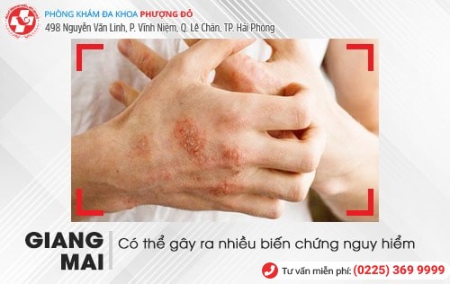 Tác hại khi mắc giang mai