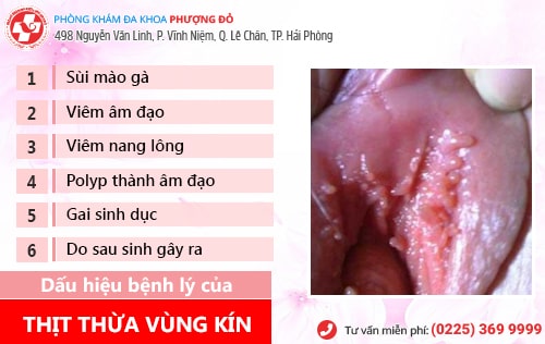 thịt thừa vùng kín thịt thừa vùng kín