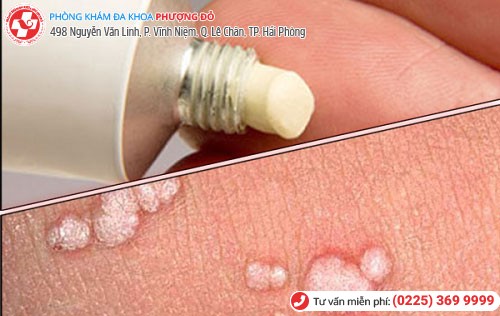Thuốc trị HPV gây bệnh sùi mào gà có thể là thuốc mỡ bôi xung quanh nốt sùi Thuốc trị HPV gây bệnh sùi mào gà có thể là thuốc mỡ bôi xung quanh nốt sùi