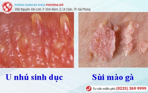 Phân biệt u nhú sinh dục và sùi mào gà Phân biệt u nhú sinh dục và sùi mào gà