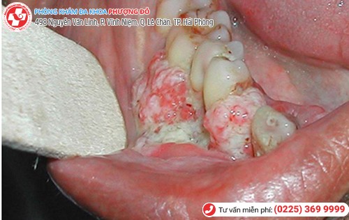 biến chứng sùi mào gà ở miệng
