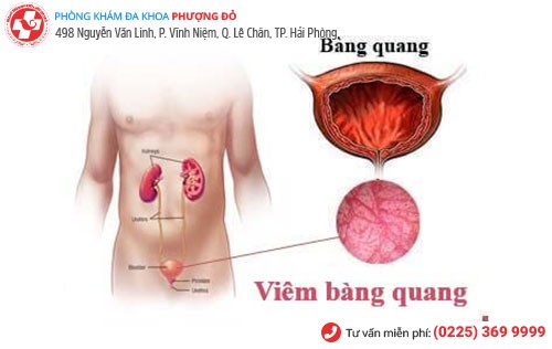 Hình ảnh viêm bàng quang Hình ảnh viêm bàng quang