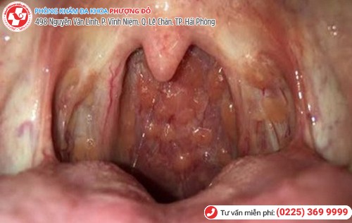 viêm họng