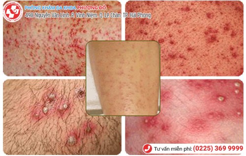 Hình ảnh viêm nang lông Hình ảnh viêm nang lông