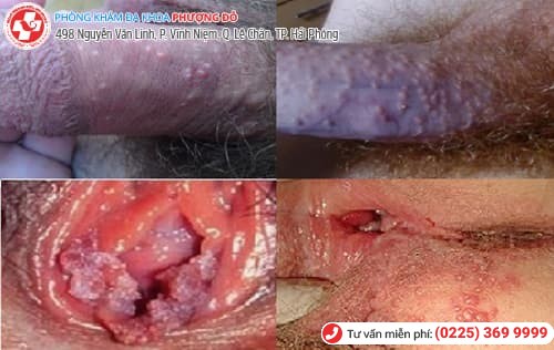 vùng kín mọc mụn
