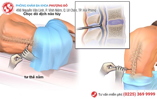 xét nghiệm dịch tủy